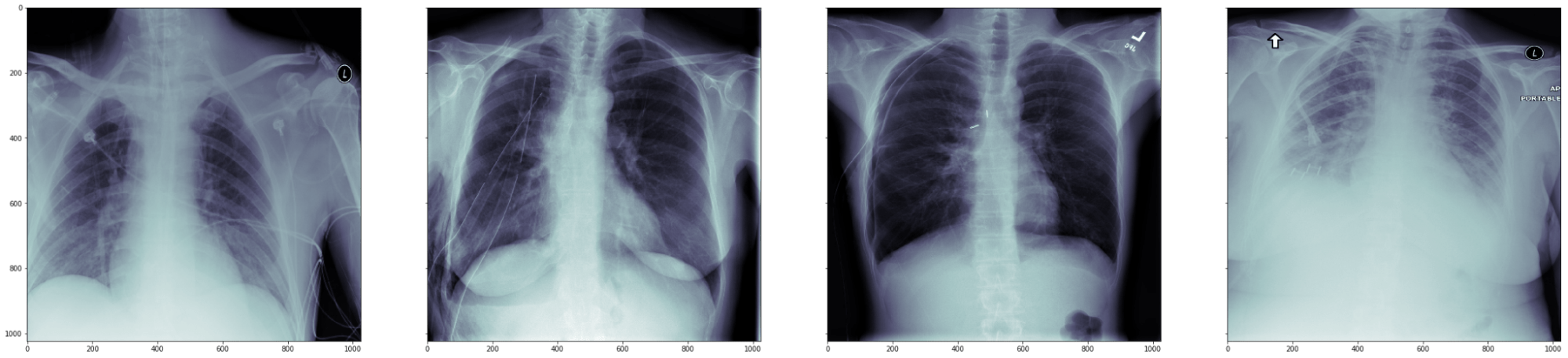 pneumothorax 