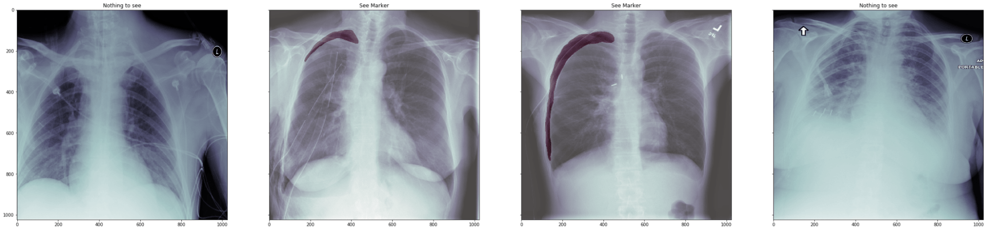 pneumothorax location