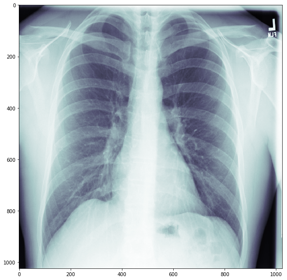 typical lung x-ray 